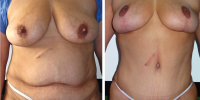 abdominoplaty and breast