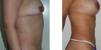 Reshape of the butt ,abdominoplasty ,breast implants
